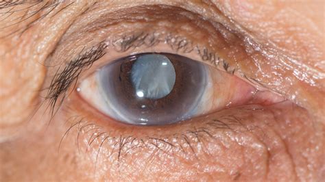 What Causes A Cataract To Form